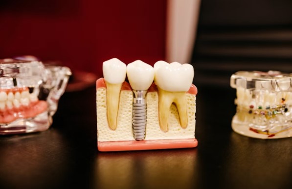 5 Tips to Find a Reliable Root Canal Therapy Mexico